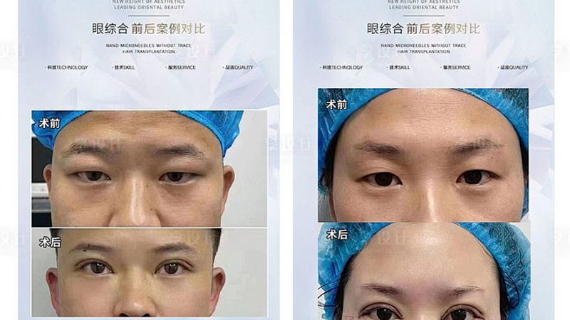 注射美容与线雕：两种流行的医美项目，有何区别？**