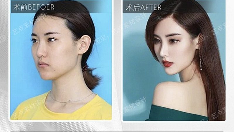 成都埋线提升：揭秘术前术后对比，了解真实效果