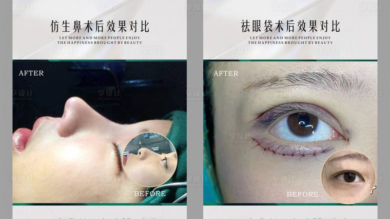 激光美容术前注意事项：安全与效果的保障
