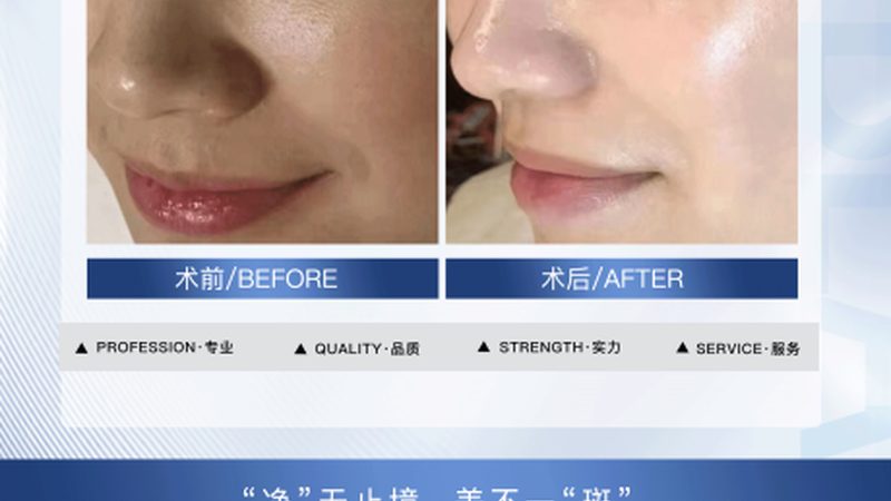 家用瘦脸仪，如何挑选适合的面部紧致提升型号？**