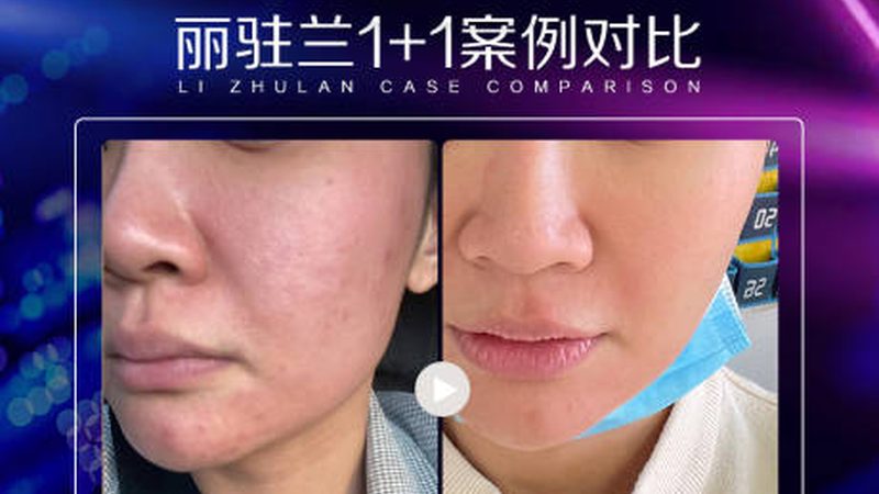医美恢复期疼痛管理：有效缓解策略全解析