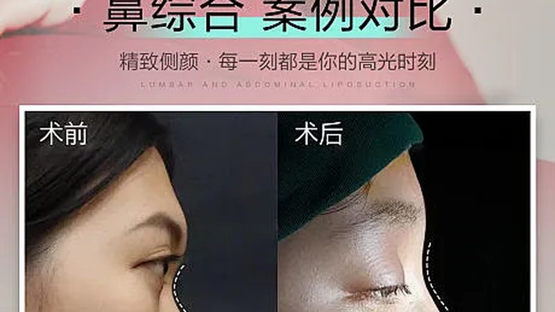 原厂配件真假混用，热玛吉效果打折的根源在哪