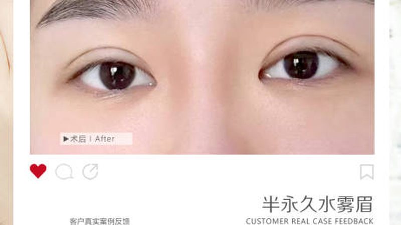 超声炮恢复期饮食注意事项：辣食能吃吗？**