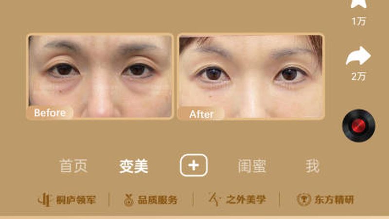 小标题：激光祛斑的注意事项